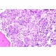Malignant Bone Marrow Pathology Symposium