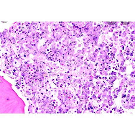 Malignant Bone Marrow Pathology Symposium