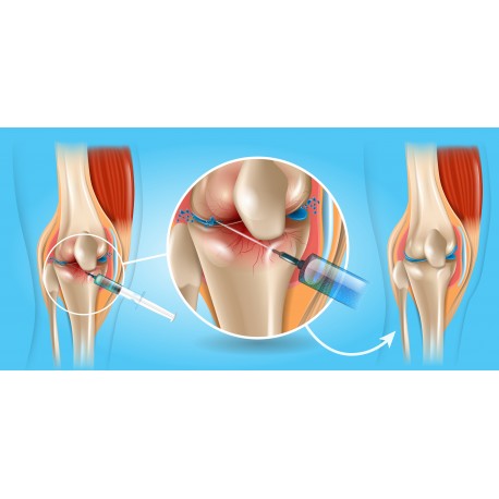 Joint Injections &amp; Minor Office Surgical procedures