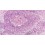 BREAST PATHOLOGY UPDATE- WORKSHOP