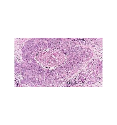 BREAST PATHOLOGY UPDATE- WORKSHOP