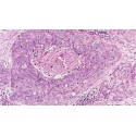 BREAST PATHOLOGY UPDATE- WORKSHOP